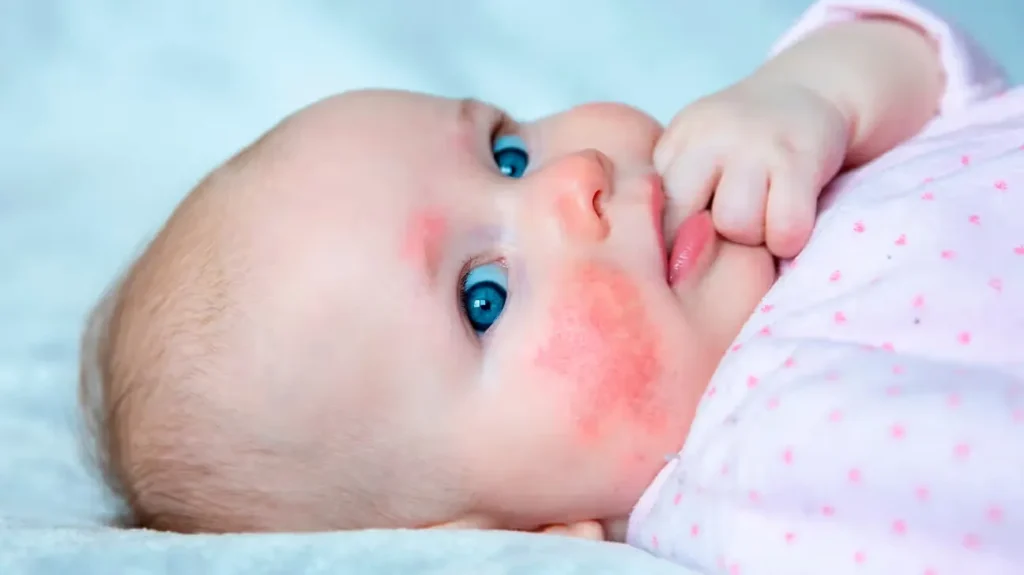 Signs of Milk Allergy in 1 Year Old