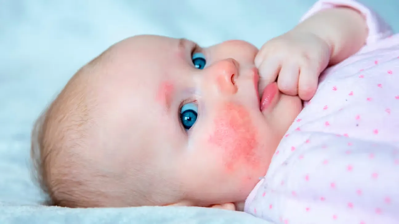 9 Clear Signs of Milk Allergy in 1 Year Old