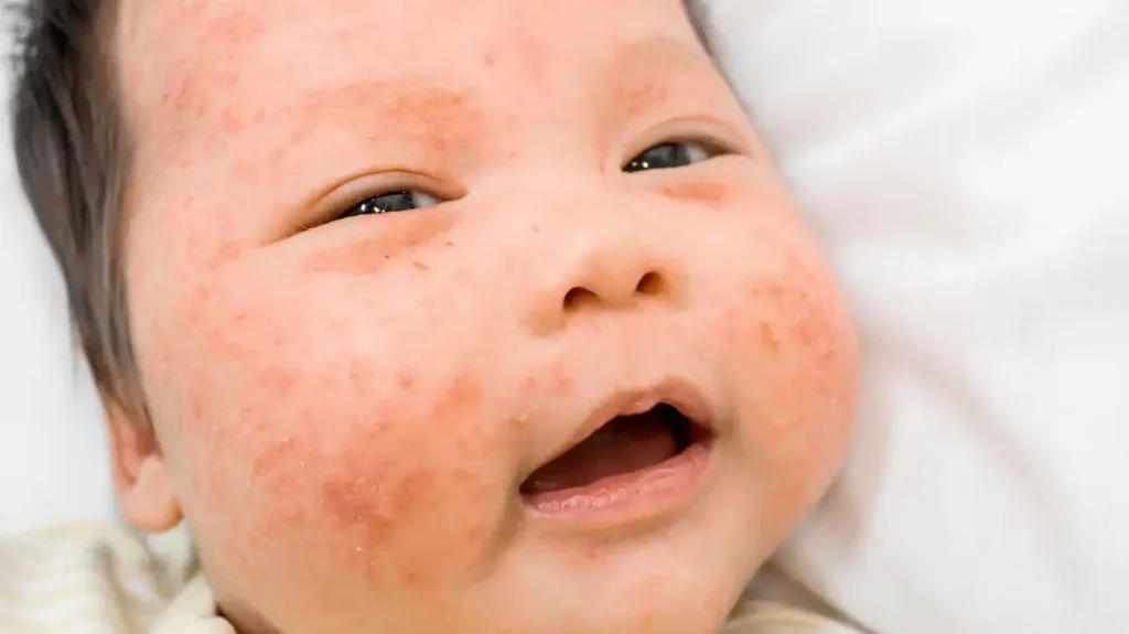 Signs of Milk Allergy in 1 Year Old